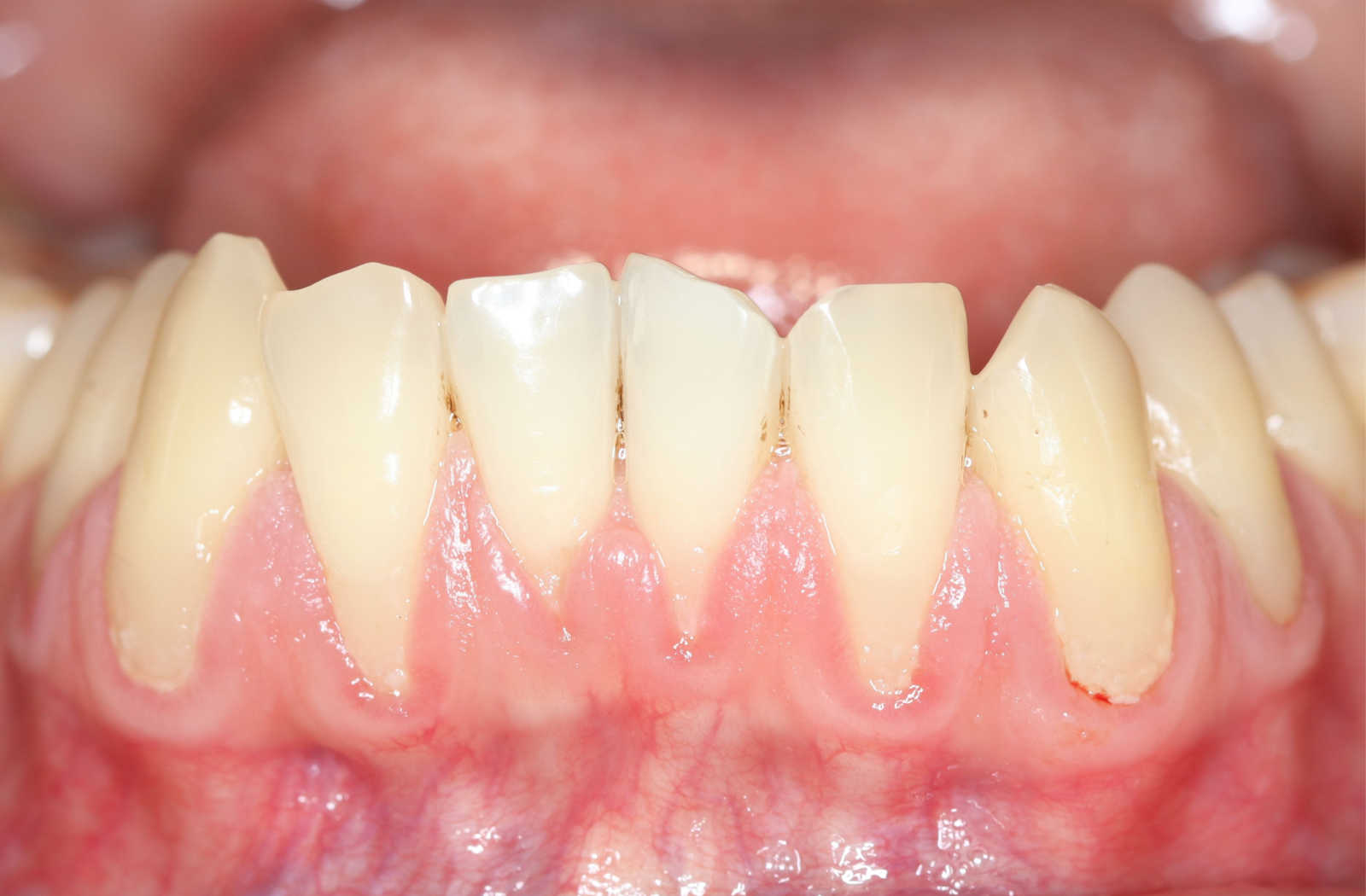 A close-up of a human mouth showing receding gums, exposure of the roots of the teeth caused by a loss of gum tissue.