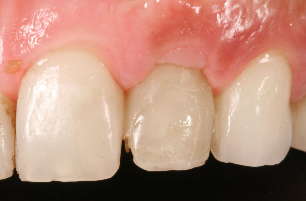 Up close after image of a gum graft on the middle tooth.