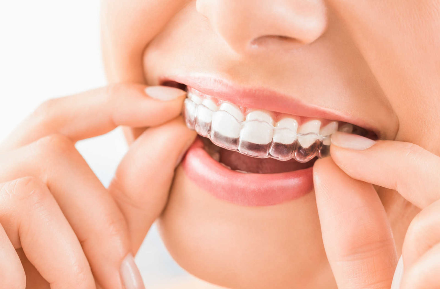 Can You Get Invisalign With Missing Teeth Calgary